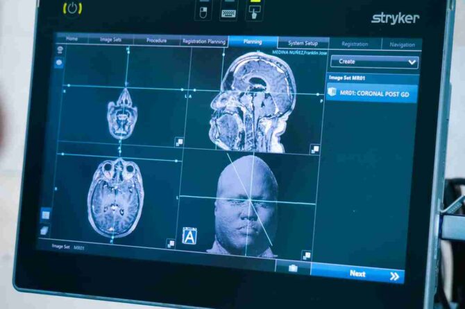 Clínicas Colina realiza con éxito resección de tumor cerebral con neuronavegador y abordaje endoscópico endonasal 1 neuronavegador clinicas colina